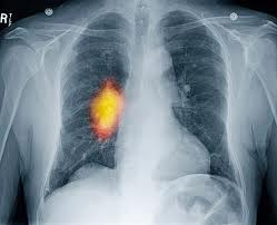 UPOZORENJE:Srbija na trećem mestu po broju obolelih od raka pluća