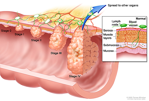 Upoznajte polipe i kancer debelog creva ispred LKC-a