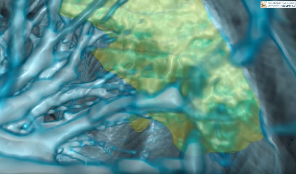 Kako izgledaju pluća napadnuta virusom korona – (VIDEO)