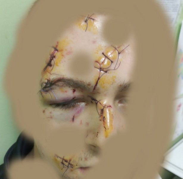Majka mladića iz Leskovca povređenog u restoranu: Moj sin nije sam sebe udario staklenim bokalom!