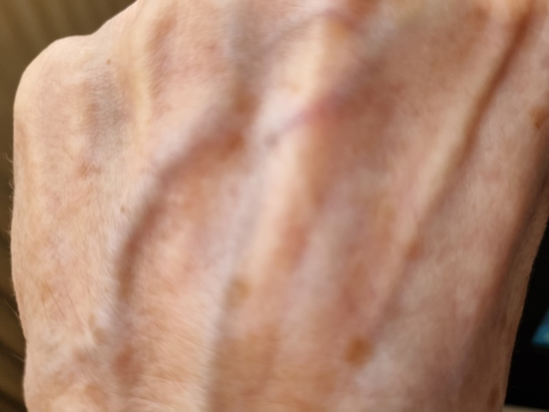 Danas se obeležava Svetski dan vitiligo – Zbog ove retke dijagnoze Majl Džekson je promenio boju kože