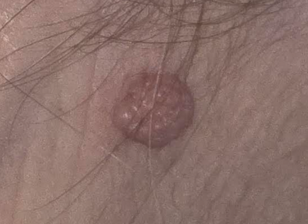 Kada mladež nije bezazlen: znakovi zbog kojih treba odmah kod dermatologa